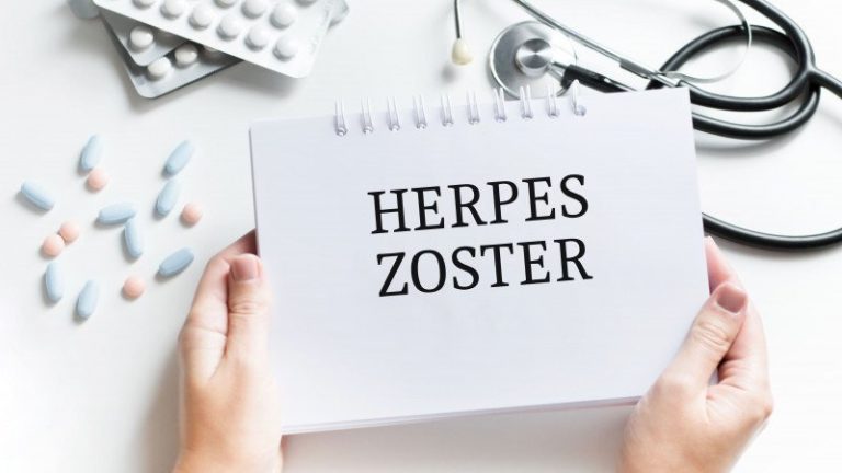 Herpes Zoster