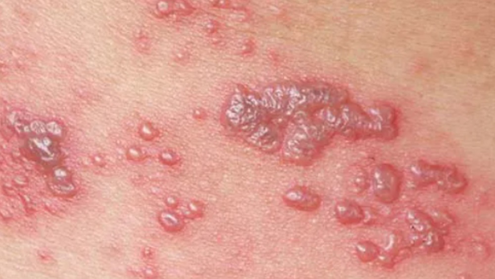 gejala impetigo