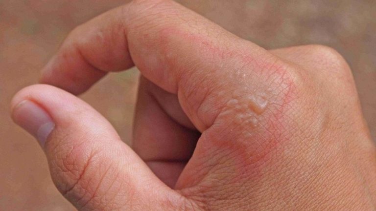 impetigo