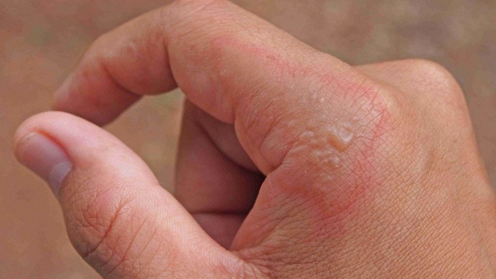 impetigo